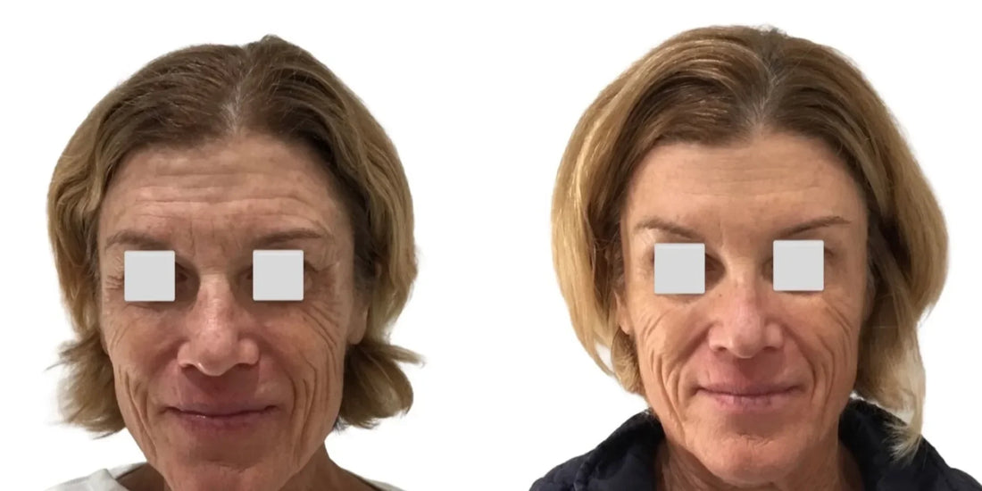 OC Skin Care Center Botox treatment setting with warm, natural clinical detail
