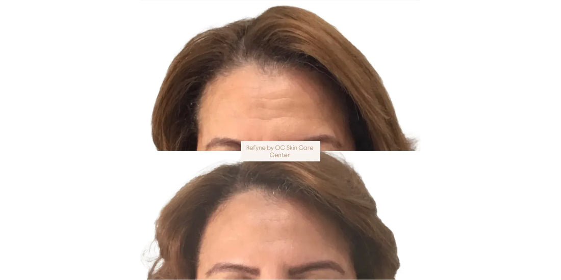 Before and after Dysport forehead line results at OC Skin Care Center