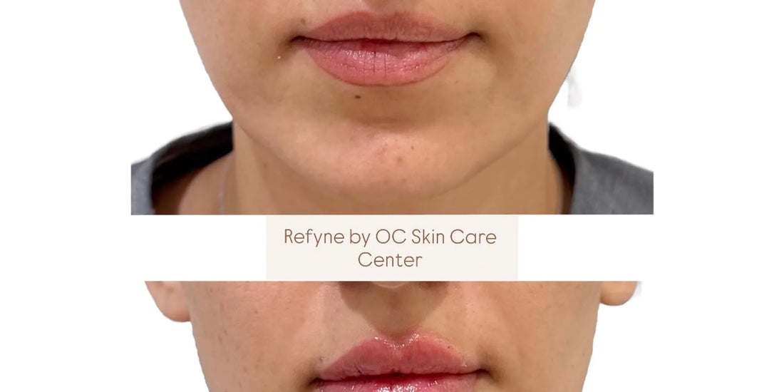 Before-and-after close-up photos showing subtle lip enhancement results from Refyne by OC Skin Care Center