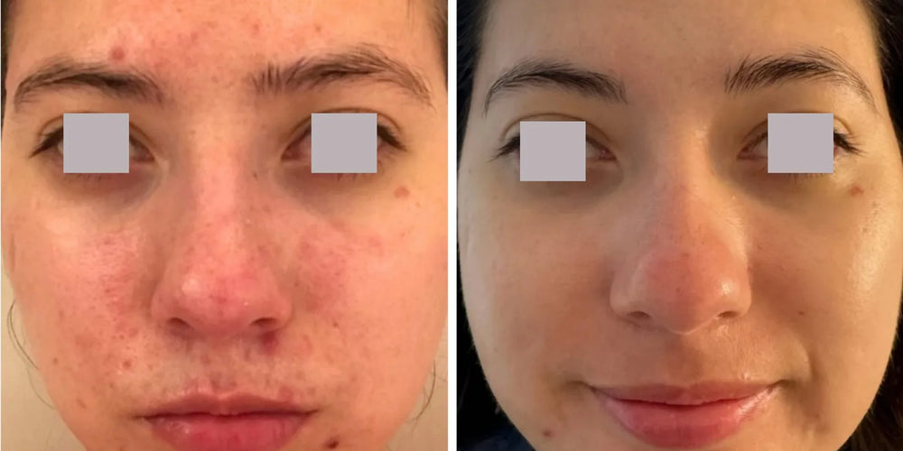 Before-and-after lip filler comparison showing subtle, balanced lip definition and volume