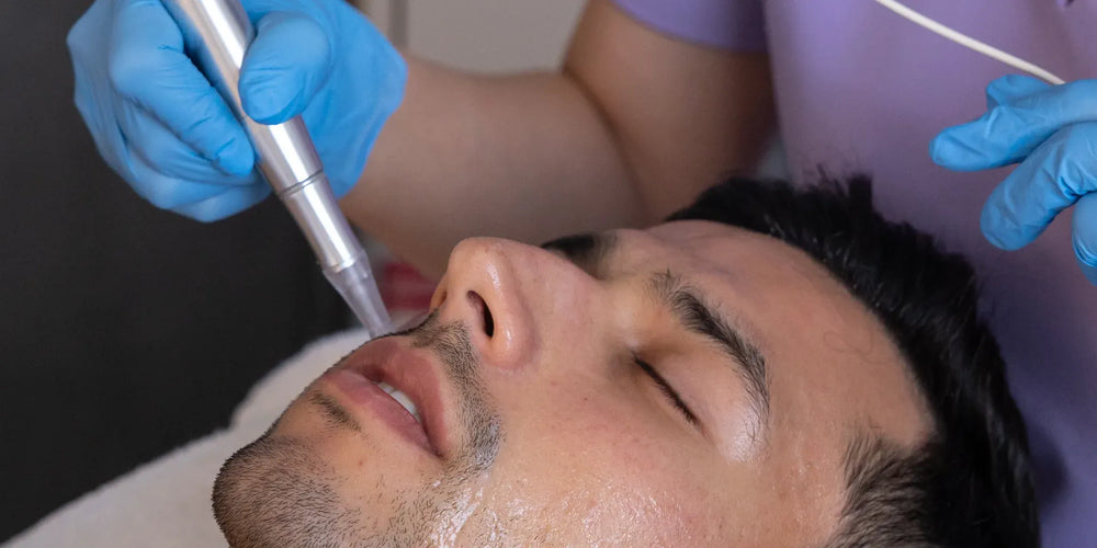 Provider performing microneedling for acne scars at OC Skin Care Center