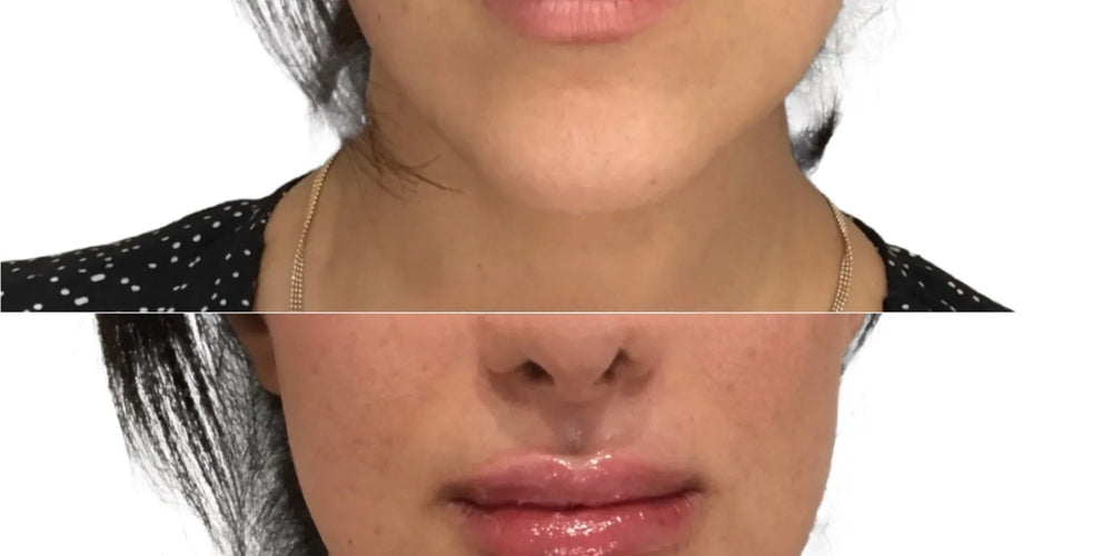 Microneedling with PRP treatment planning in Newport Beach