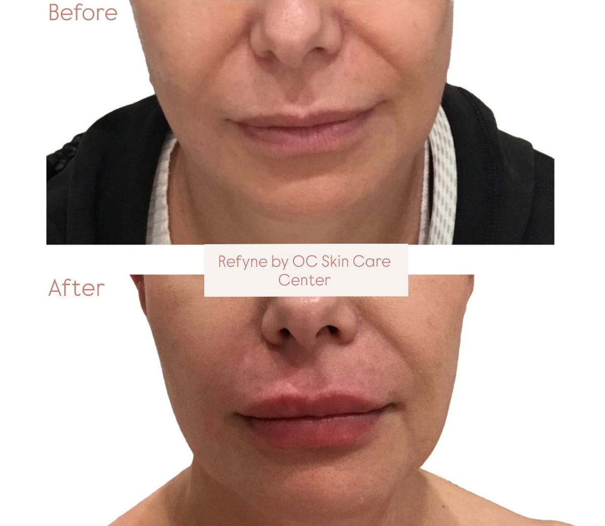 Botox Center Botox Newport Beach | OC Skin Care Center