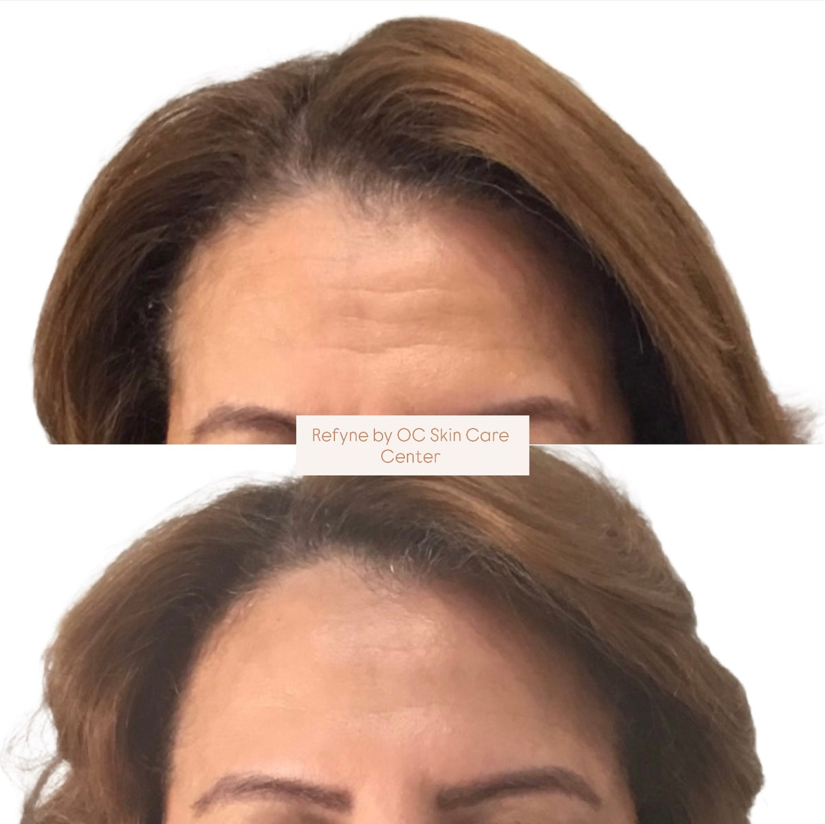 Botox Center Botox Newport Beach | OC Skin Care Center
